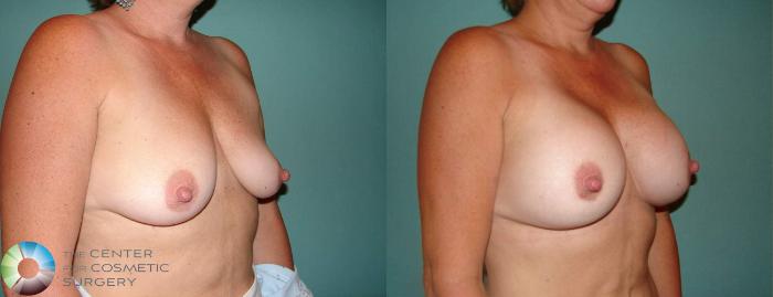Before & After Breast Augmentation Case 527 View #3 in Denver and Colorado Springs, CO