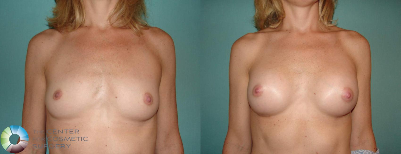 Before & After Breast Augmentation Case 528 View #1 in Denver and Colorado Springs, CO