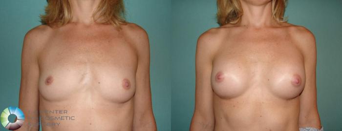 Before & After Breast Augmentation Case 528 View #1 View in Golden, CO