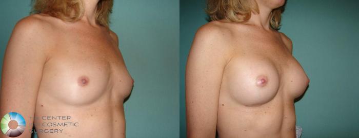 Before & After Breast Augmentation Case 528 View #2 View in Golden, CO