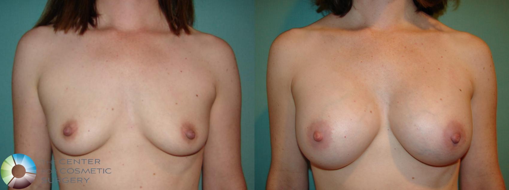 Before & After Breast Augmentation Case 529 View #1 in Denver, CO