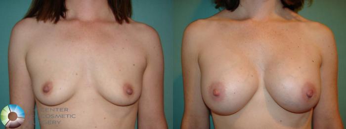 Before & After Breast Augmentation Case 529 View #1 View in Golden, CO