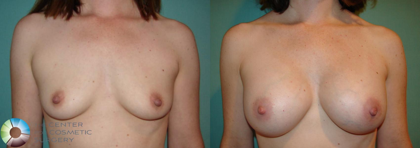 Before & After Breast Augmentation Case 529 View #2 in Denver and Colorado Springs, CO