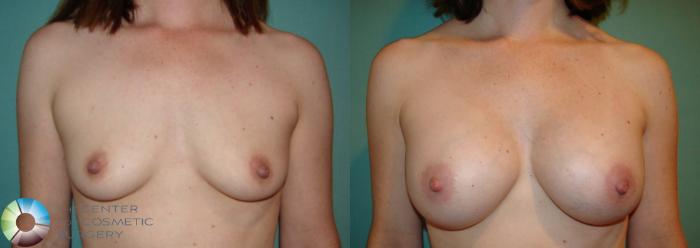 Before & After Breast Augmentation Case 529 View #2 View in Golden, CO