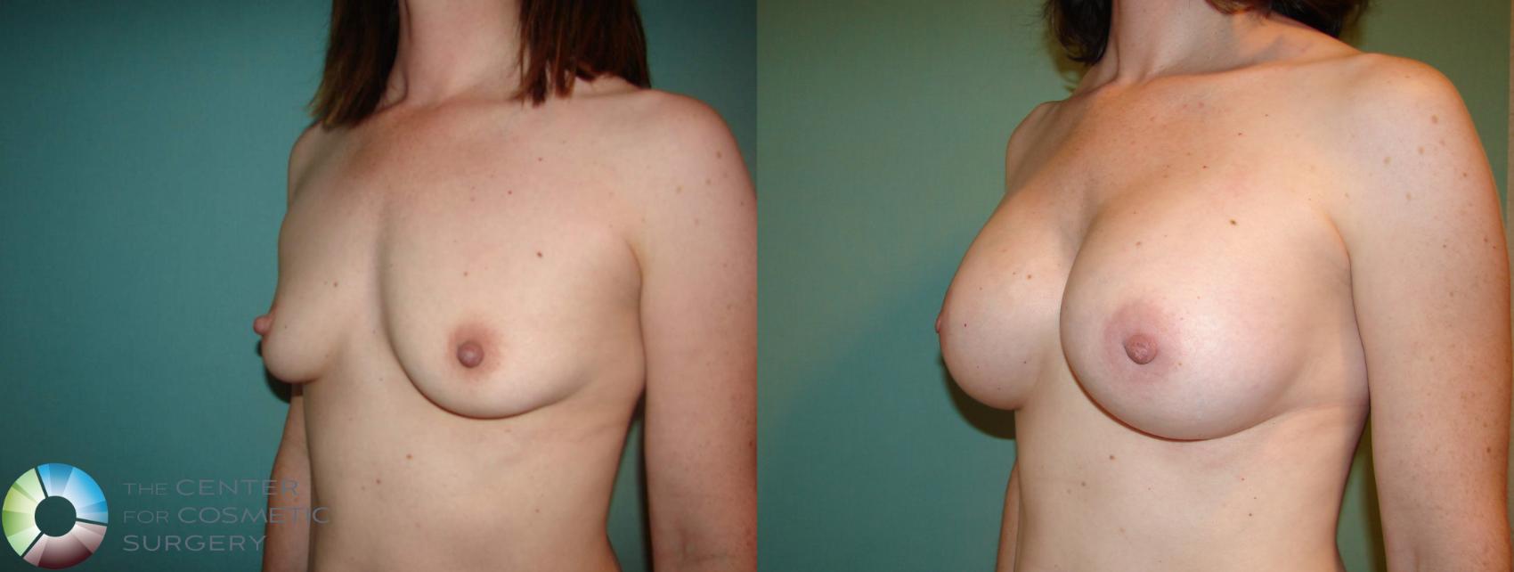 Before & After Breast Augmentation Case 529 View #3 in Denver and Colorado Springs, CO