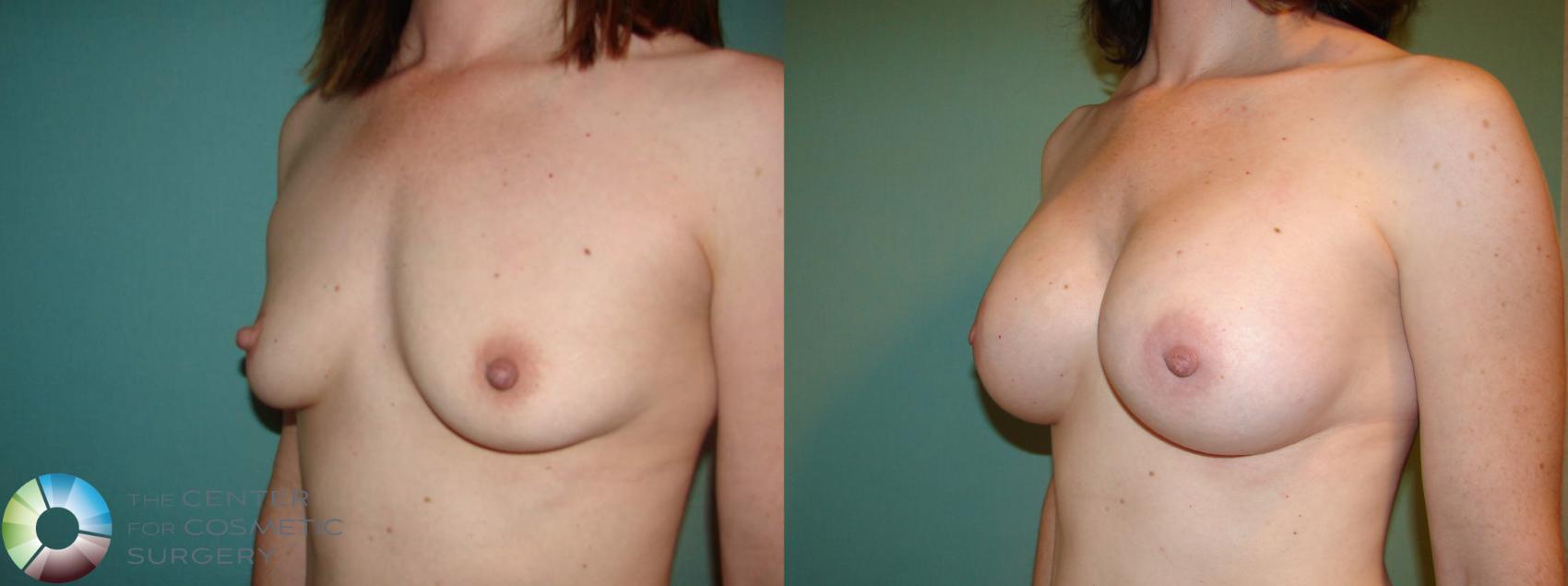Before & After Breast Augmentation Case 529 View #5 in Denver and Colorado Springs, CO
