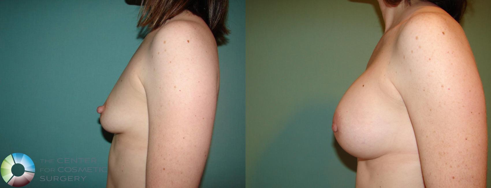 Before & After Breast Augmentation Case 529 View #6 in Denver and Colorado Springs, CO