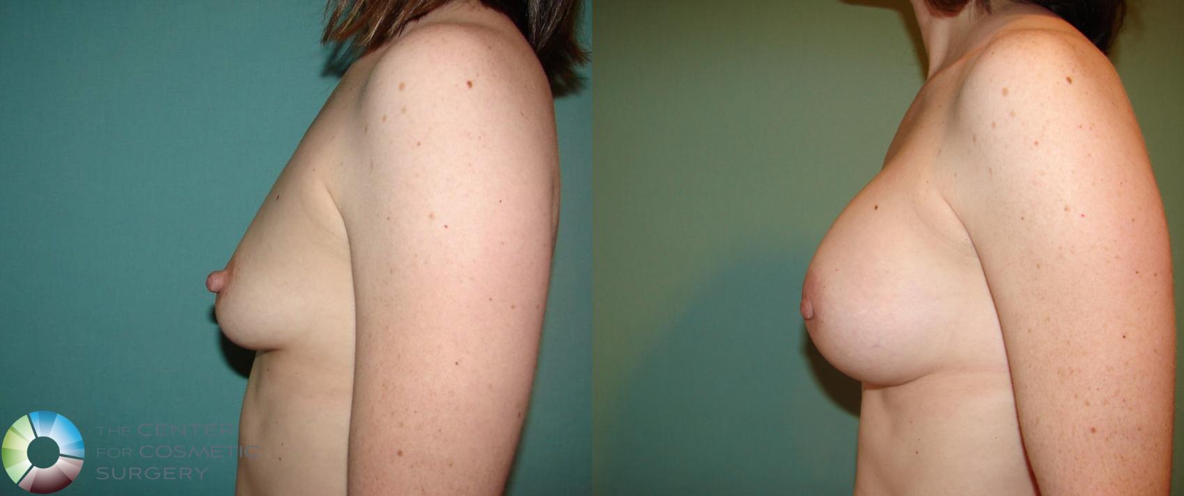 Before & After Breast Augmentation Case 529 View #7 in Denver and Colorado Springs, CO
