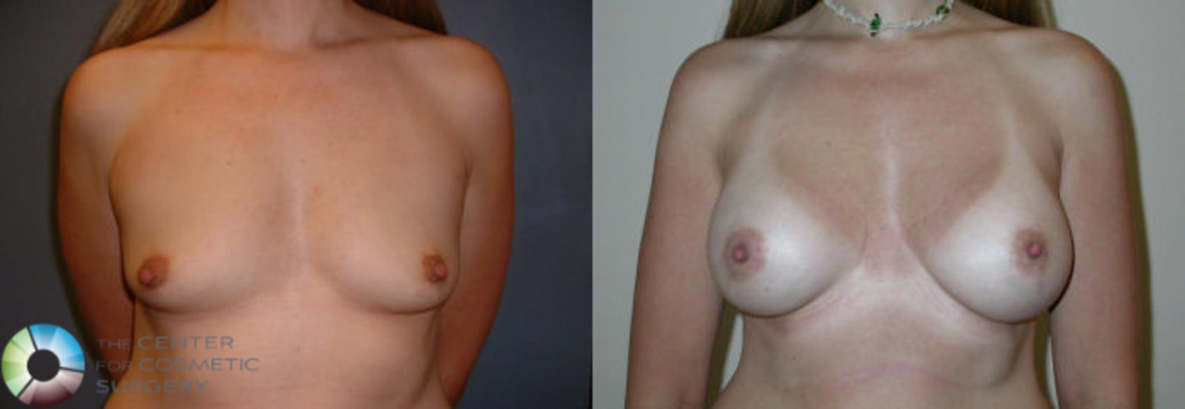 Before & After Breast Augmentation Case 53 View #1 in Denver and Colorado Springs, CO