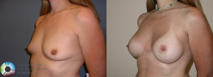 Before & After Breast Augmentation Case 53 View #2 View in Golden, CO
