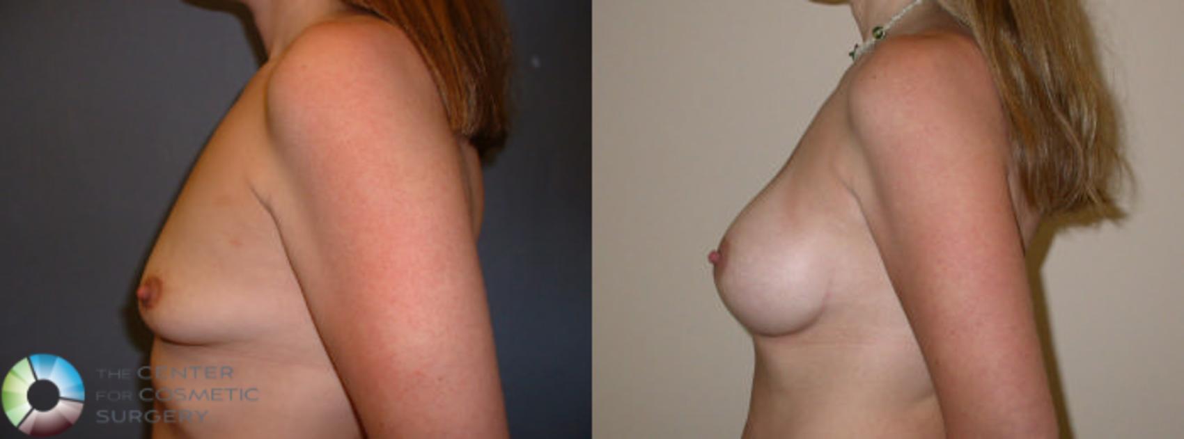 Before & After Breast Augmentation Case 53 View #3 View in Golden, CO