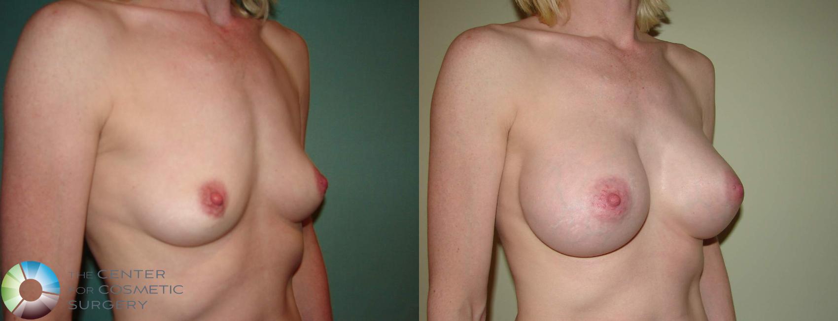 Before & After Breast Augmentation Case 599 View #1 in Denver and Colorado Springs, CO