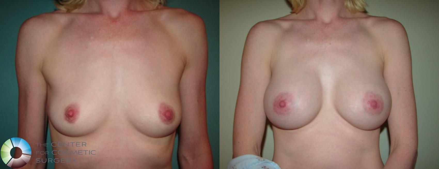 Before & After Breast Augmentation Case 599 View #3 View in Golden, CO