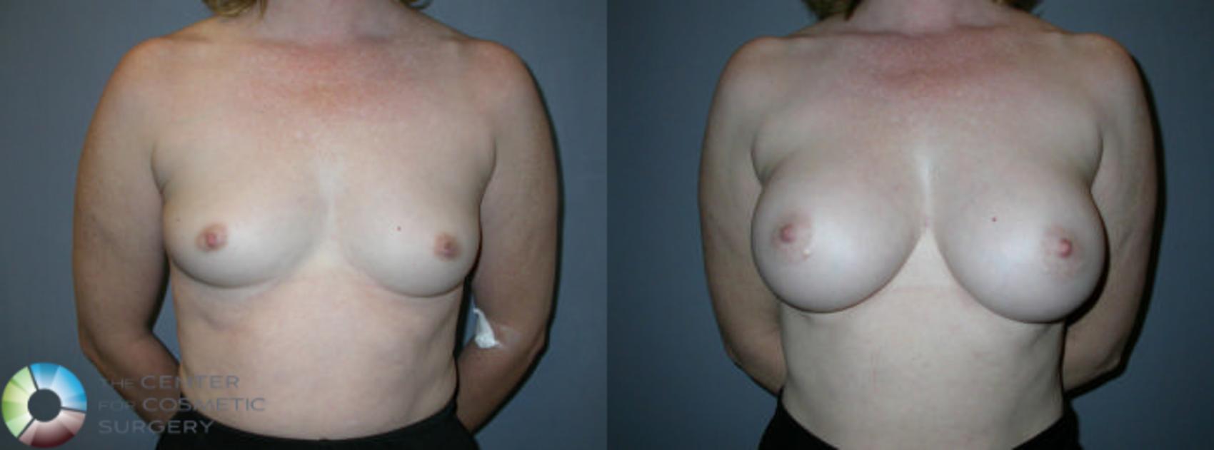 Before & After Breast Augmentation Case 61 View #1 in Denver and Colorado Springs, CO