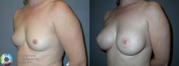 Before & After Breast Augmentation Case 61 View #2 View in Golden, CO