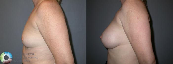 Before & After Breast Augmentation Case 61 View #3 View in Golden, CO