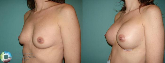 Before & After Breast Augmentation Case 615 View #2 View in Golden, CO