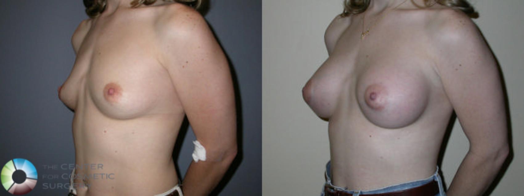 Before & After Breast Augmentation Case 63 View #1 in Denver and Colorado Springs, CO