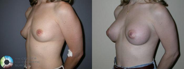 Before & After Breast Augmentation Case 63 View #1 View in Golden, CO