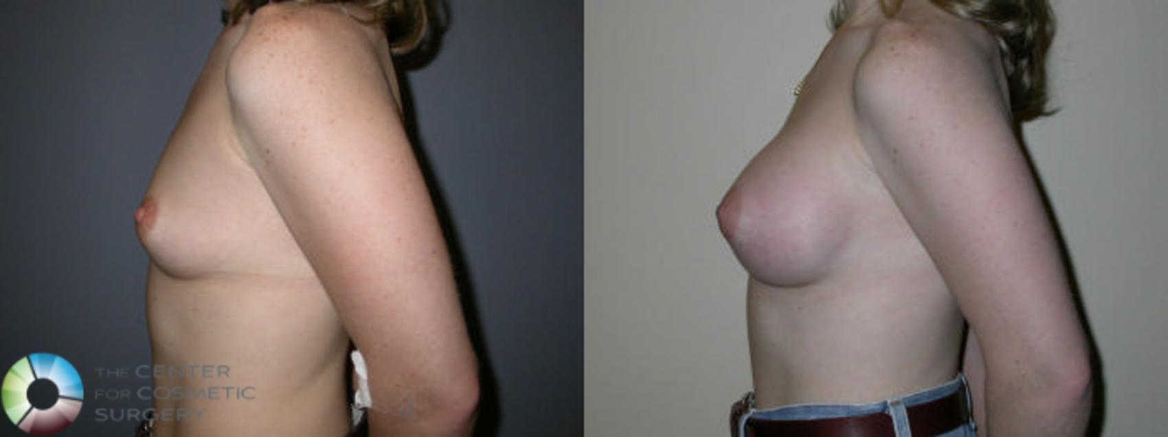 Before & After Breast Augmentation Case 63 View #2 in Denver and Colorado Springs, CO