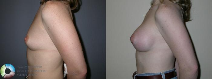 Before & After Breast Augmentation Case 63 View #2 View in Golden, CO