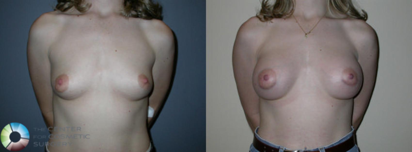 Before & After Breast Augmentation Case 63 View #3 in Denver and Colorado Springs, CO