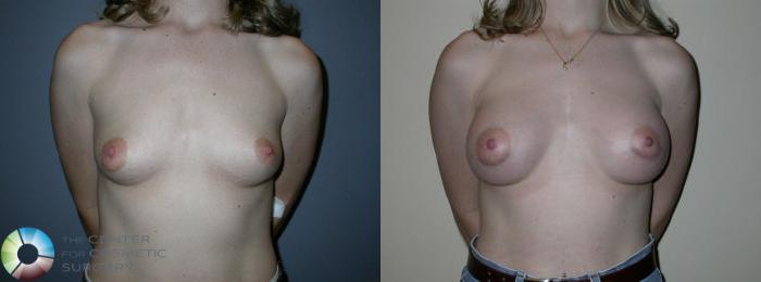 Before & After Breast Augmentation Case 63 View #3 View in Golden, CO
