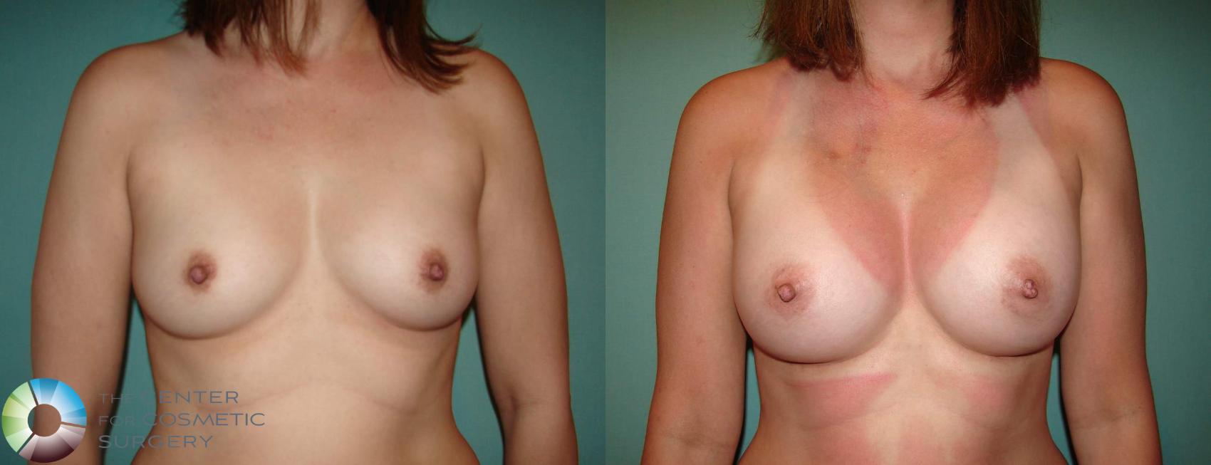 Before & After Breast Augmentation Case 638 View #1 in Denver and Colorado Springs, CO