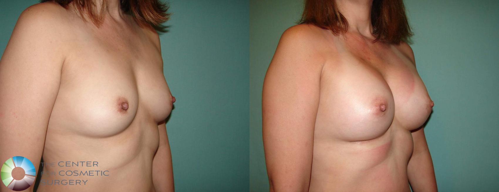 Before & After Breast Augmentation Case 638 View #2 in Denver and Colorado Springs, CO