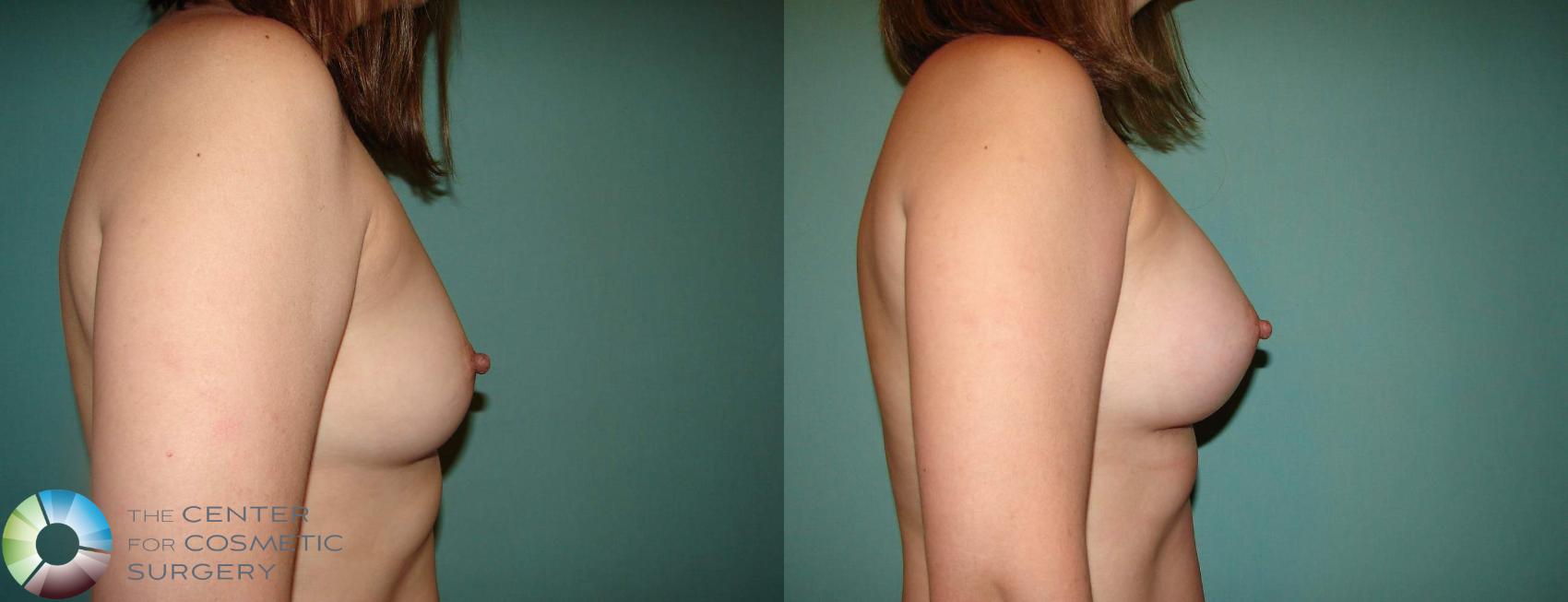 Before & After Breast Augmentation Case 638 View #3 in Denver and Colorado Springs, CO