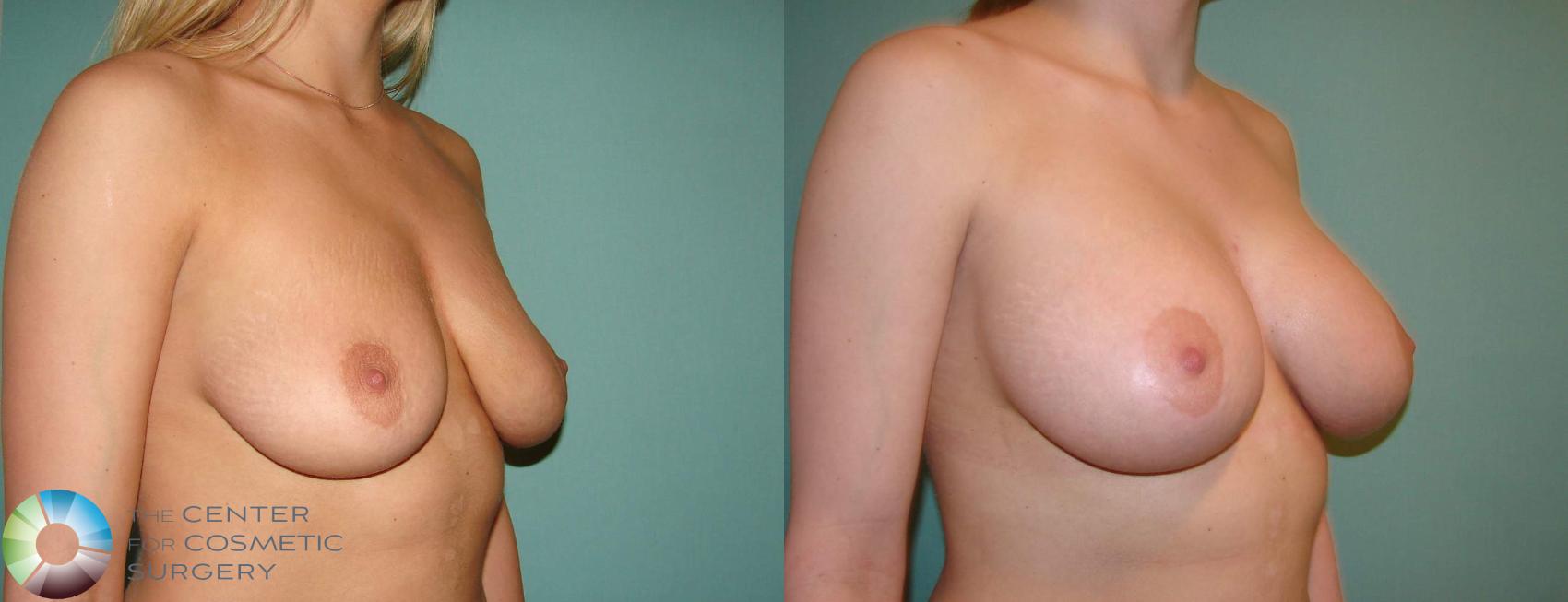 Before & After Breast Augmentation Case 659 View #2 View in Golden, CO