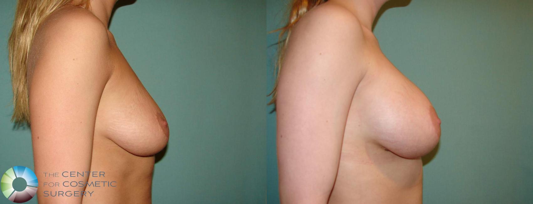 Before & After Breast Augmentation Case 659 View #3 View in Golden, CO