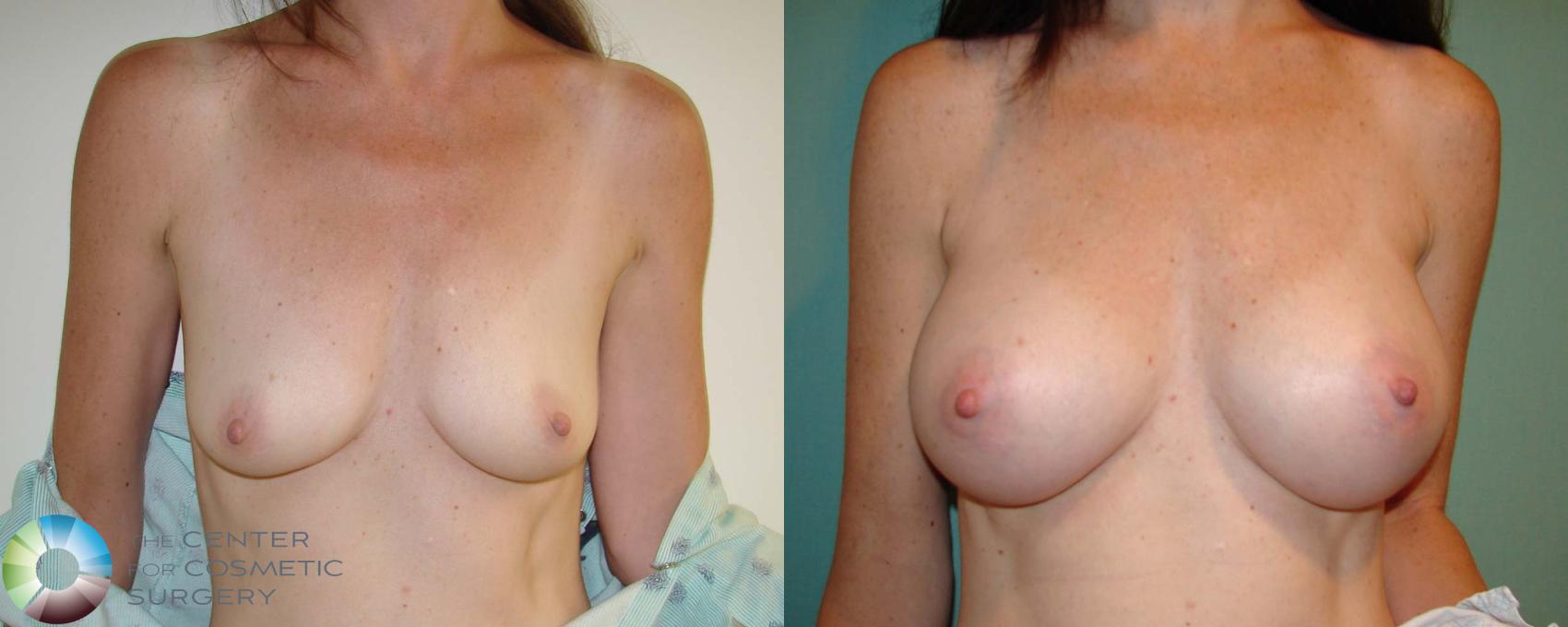 Before & After Breast Augmentation Case 667 View #1 in Denver and Colorado Springs, CO