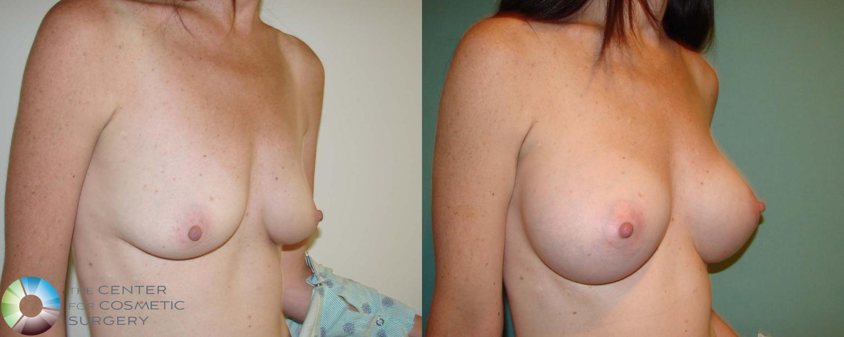 Before & After Breast Augmentation Case 667 View #2 in Denver and Colorado Springs, CO