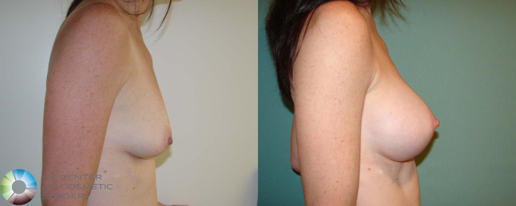 Before & After Breast Augmentation Case 667 View #3 in Denver and Colorado Springs, CO