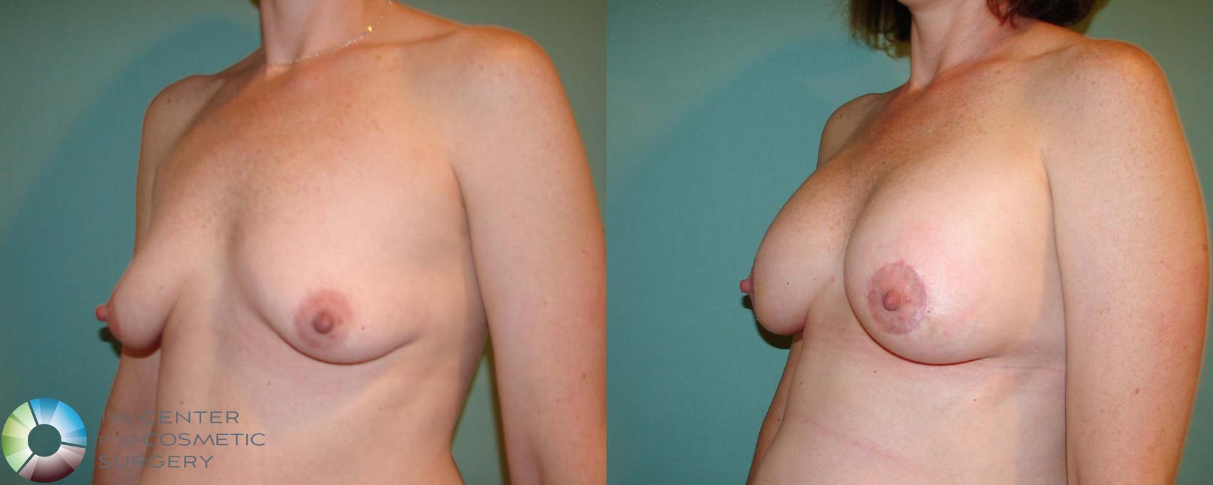 Before & After Breast Augmentation Case 668 View #1 in Denver and Colorado Springs, CO