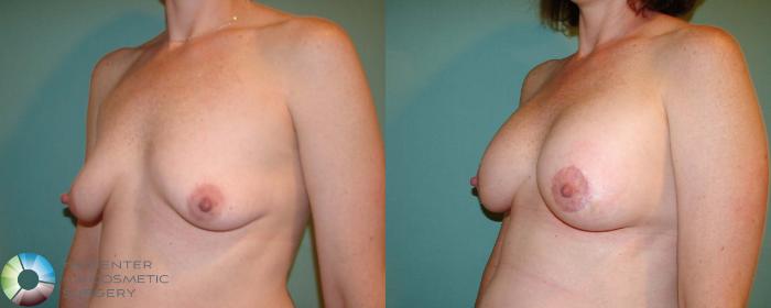 Before & After Breast Augmentation Case 668 View #1 in Denver, CO
