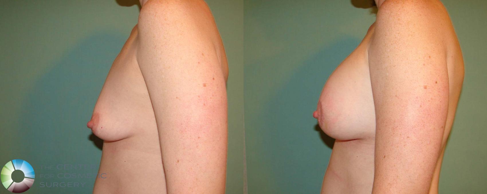 Before & After Breast Augmentation Case 668 View #2 in Denver and Colorado Springs, CO