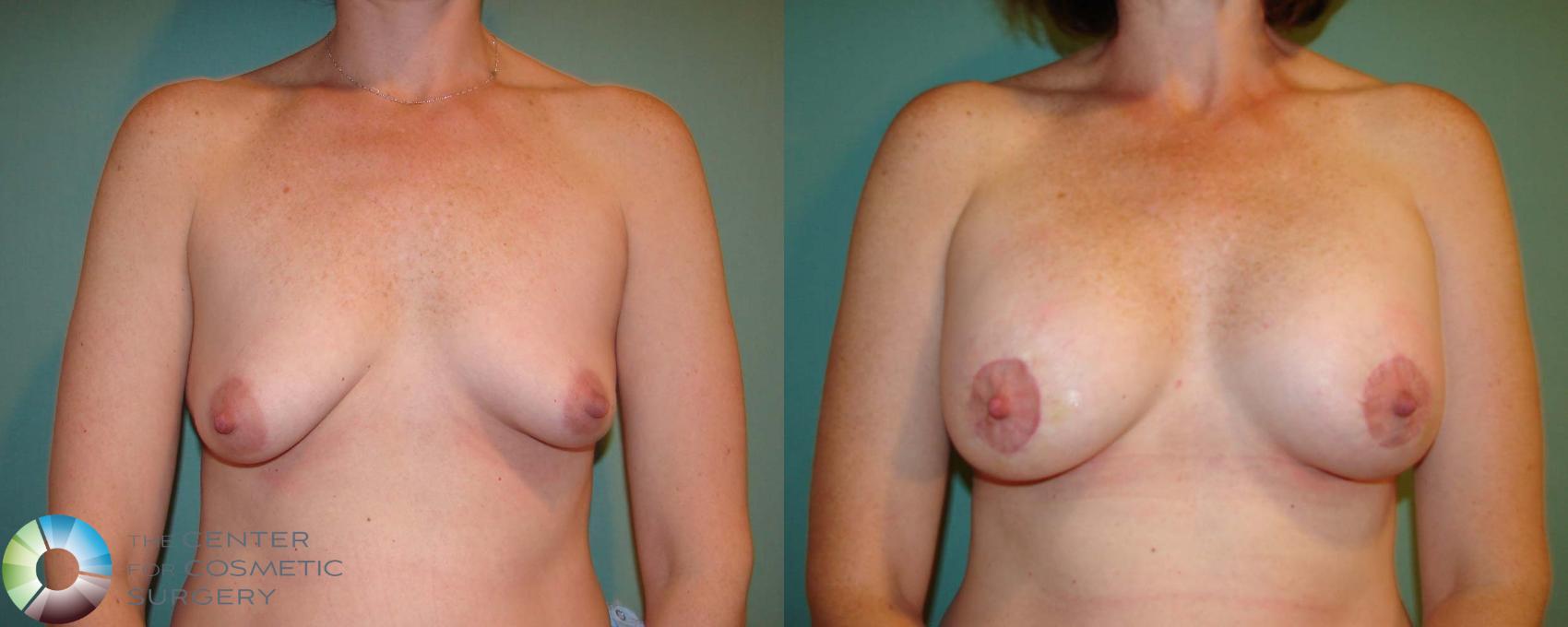 Before & After Breast Augmentation Case 668 View #3 in Denver and Colorado Springs, CO