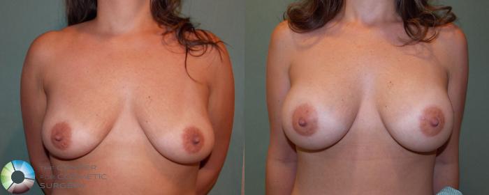 Before & After Breast Augmentation Case 682 View #1 in Denver and Colorado Springs, CO