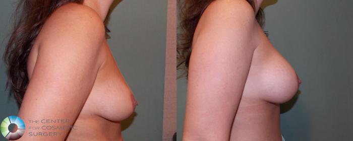 Before & After Breast Augmentation Case 682 View #3 in Denver and Colorado Springs, CO