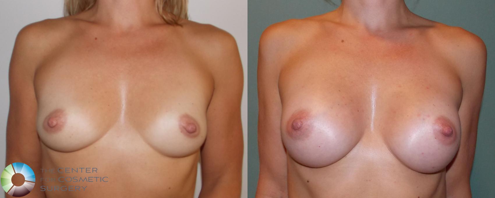 Before & After Breast Augmentation Case 695 View #1 in Denver and Colorado Springs, CO