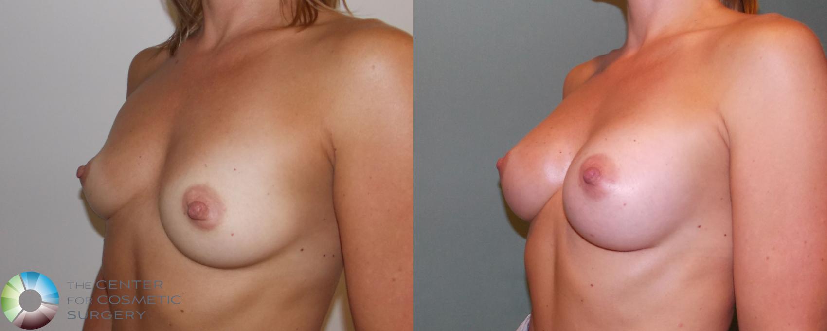 Before & After Breast Augmentation Case 695 View #2 View in Golden, CO