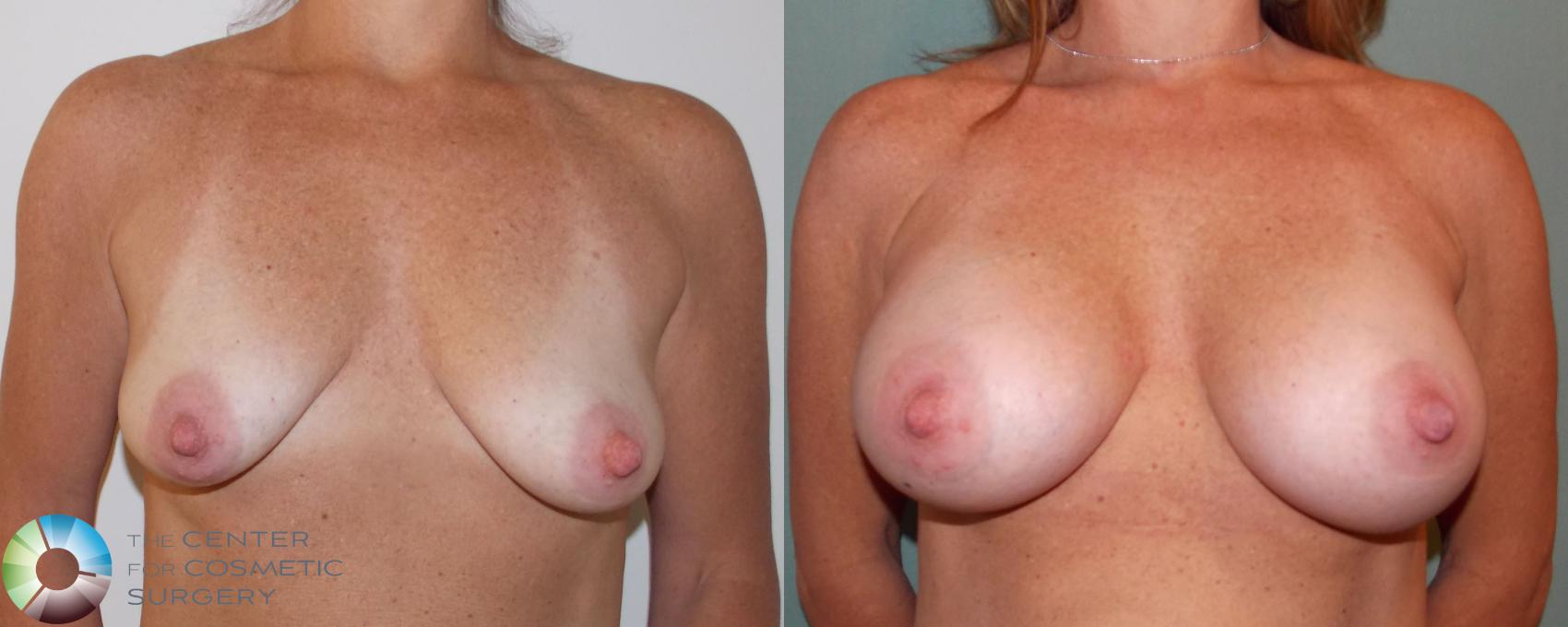 Before & After Breast Augmentation Case 696 View #1 in Denver and Colorado Springs, CO