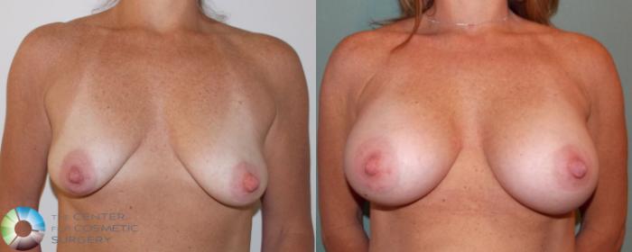 Before & After Breast Augmentation Case 696 View #1 View in Golden, CO