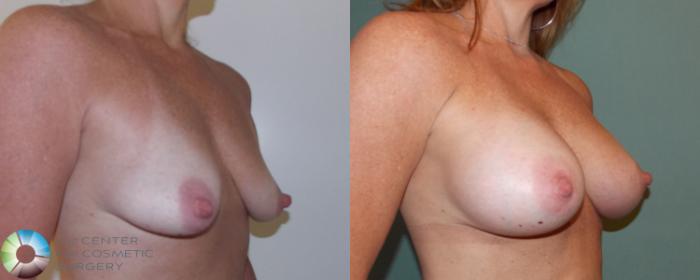 Before & After Breast Augmentation Case 696 View #2 View in Golden, CO