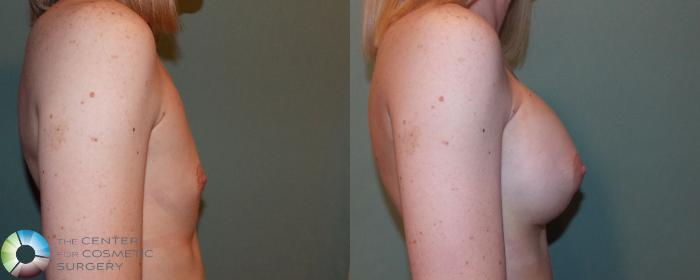 Before & After Breast Augmentation Case 705 View #1 View in Golden, CO