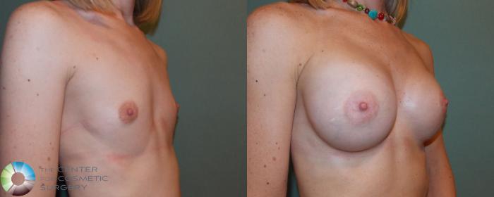 Before & After Breast Augmentation Case 705 View #2 View in Golden, CO