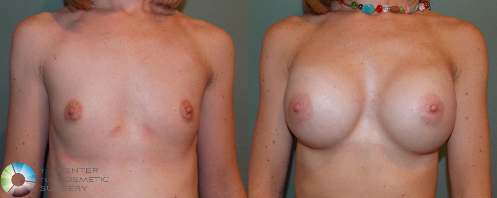 Before & After Breast Augmentation Case 705 View #3 View in Golden, CO