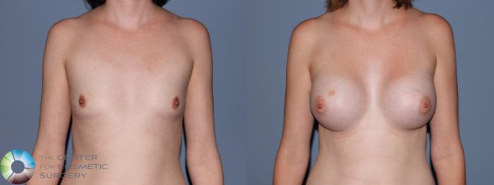 Before & After Breast Augmentation Case 707 View #1 in Denver and Colorado Springs, CO